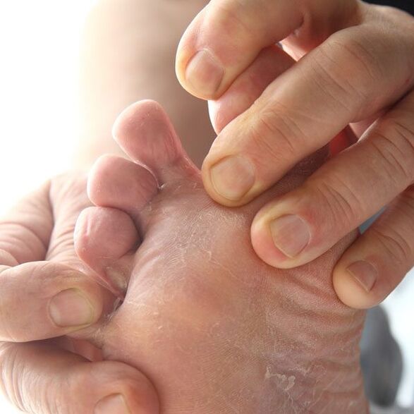 El hongo afecta la piel entre los dedos de los pies. 