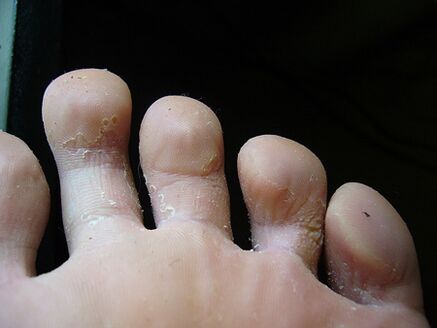 La descamación y descamación de la piel de las piernas es un signo de hongos. 