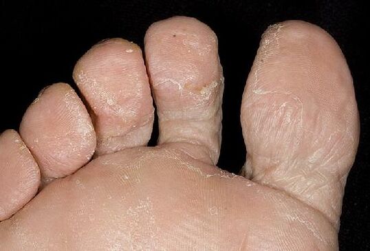 Manifestaciones de una infección por hongos en los pies. 