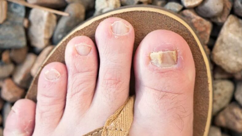Micosis de uñas