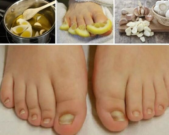 Remedios populares para hongos de uñas