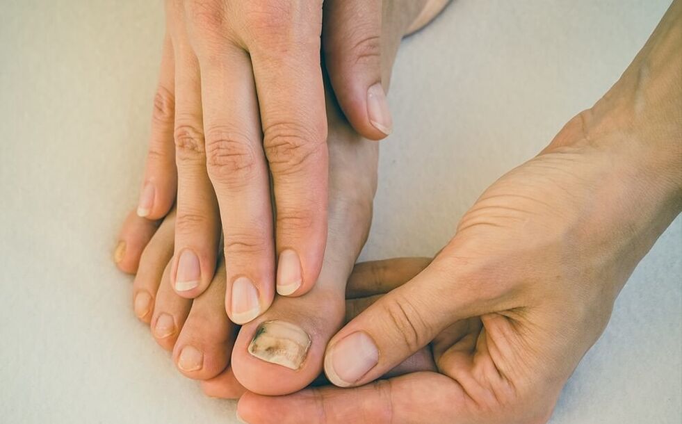 hongos en las uñas de los pies como tratarlos
