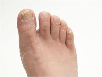 sintomas de hongos en los pies