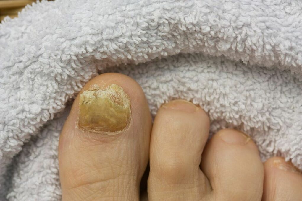 Etapa atrófica del hongo (caída de pedazos de la uña del pie)