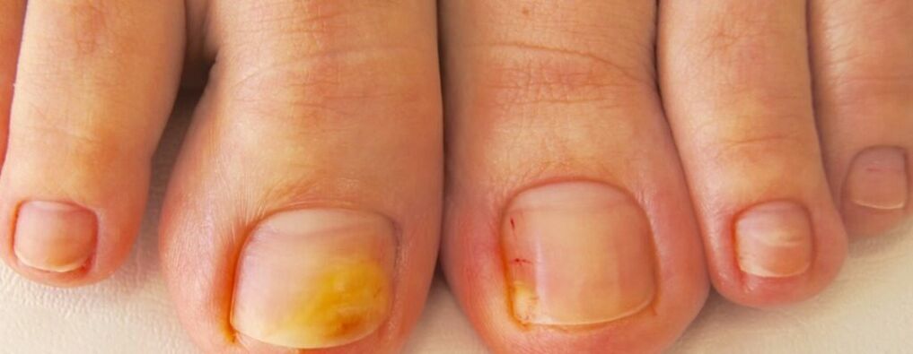 La etapa inicial de la onicomicosis coloración amarillenta de las uñas de los pies. 
