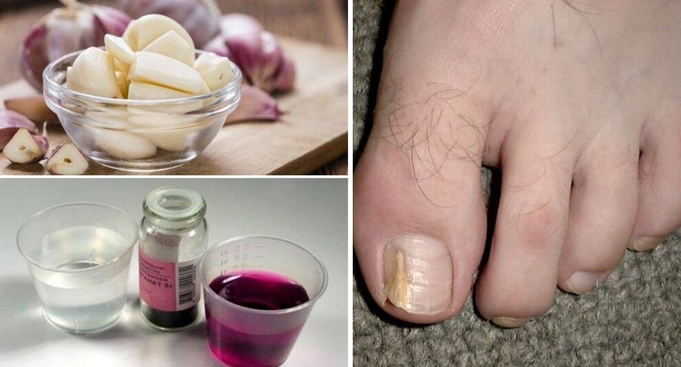 ajo y permanganato de potasio para hongos en las uñas de los pies