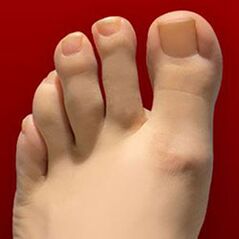 Hongo de uñas