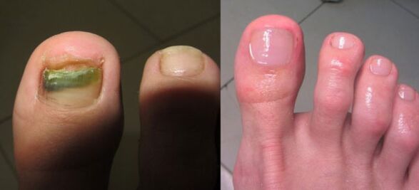 Tratamiento del hongo de las uñas