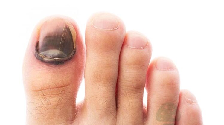 La etapa de carrera de la enfermedad con un hongo de la uña del pulgar