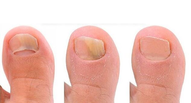 etapas de desarrollo de hongos en las uñas de los pies