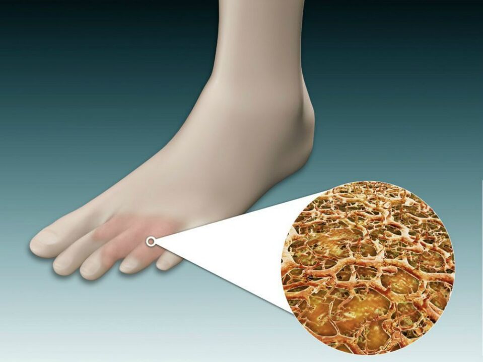Enrojecimiento de la piel entre y cerca de los dedos de los pies con hongos intertriginosos. 