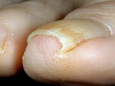 Aspecto de las uñas de los pies infectadas con hongos. 