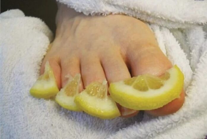 Compresas de gotas de limón un remedio popular para los hongos en las uñas de los pies